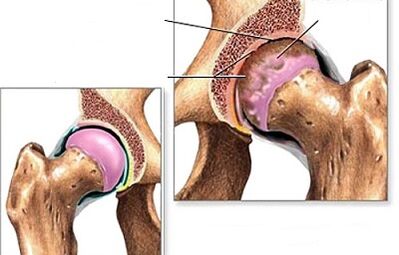 Diagnosis of hip arthrosis