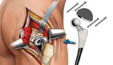 Hip arthrosis endoprothetics