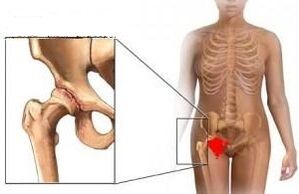 The causes of the development of arthrosis of the hip joint