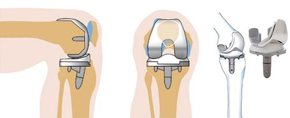Endoprotetic knee joint surgery for arthrosis