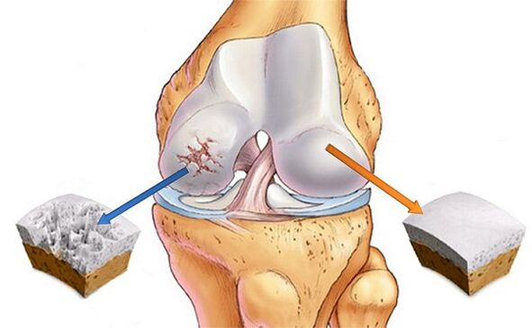 Norm and deviation for knee arthrosis joint