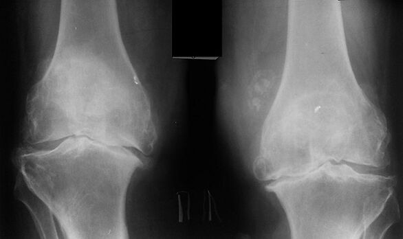 X -ra as a way to diagnose knee arthrosis joint