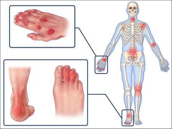 Skin redness and swelling of the joints with arthritis