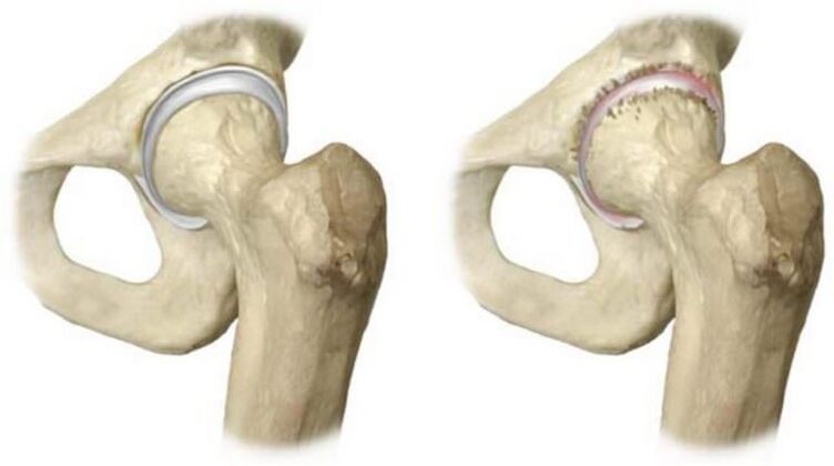 healthy hip joint and necrosis of the head as the cause of pain