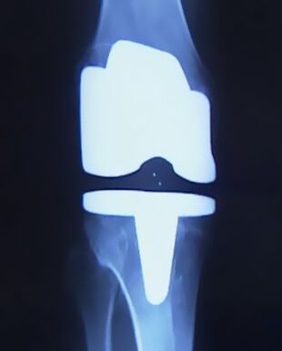 X-ray of a knee with an artificial prosthesis after joint replacement surgery
